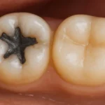 آینده آمالگام در دندانپزشکی: آیا شاهد افول یک ماده ترمیمی با سابقه خواهیم بود؟